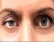 افتادگی پلک چشم