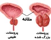 بزرگ شدن پروستات