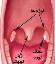 لوزه و سنگ لوزه