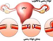 بستن لوله رحمی برای جلوگیری از بارداری
