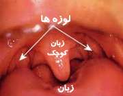 لوزه ها