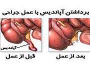 قبل و بعد از عمل آپاندیس