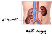 پیوند کلیه