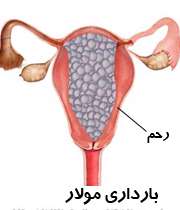بارداری مولار