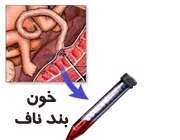خون بند ناف نوزاد