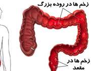 کولیت زخمی