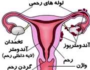 آندومتریوز