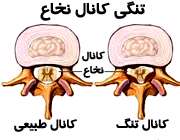 تنگی کانال نخاع