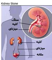 سنگ کلیه