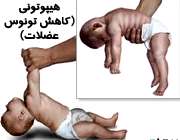 هیپوتونی