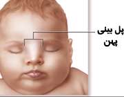 پل بینی پهن