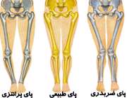 پای پرانتزی