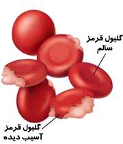 کم خونی همولیتیک