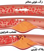 تصلب شرایین