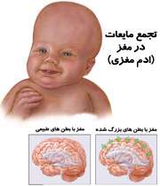 هیدروسفالی هیدروسفالی