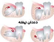 دندان نهفته