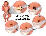 مراقبت از بند ناف نوزاد