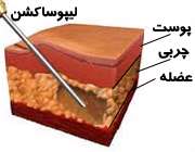 لیپولیز
