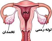 چسبندگی لوله رحمی