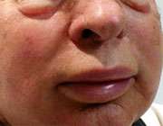 صورت پف کرده
