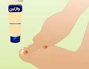 قارچ انگشتان پا