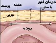 فتق