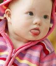سندرم داون
