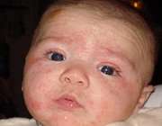 آلرژی غذایی کودک