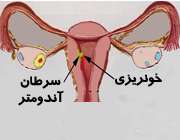 سرطان رحم