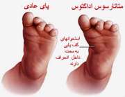متاتارتوس اداکتوس