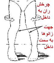 کج گذاشتن پا در کودکان