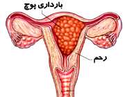 بارداری مولار