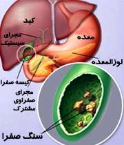 سنگ کیسه صفرا
