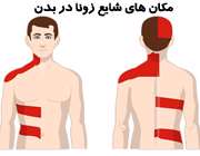 بیماری زونا