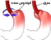 جراحی ریفلاکس معده