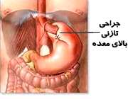 جراحی ریفلاکس معده