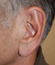 جراحی زیبایی گوش