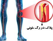 لنگیدن پا