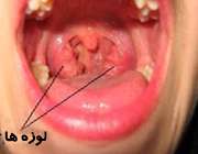 عفونت لوزه