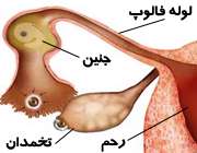 بارداری خارج از رحم