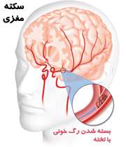 سکته مغزی