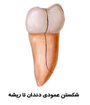 شکستن عمودی ریشه دندان