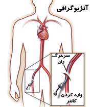 آنژیوگرافی