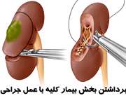 عمل جراحی کلیه