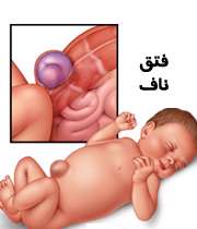 فتق ناف