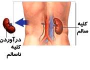 نفروکتومی