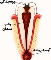 آبسه دندان