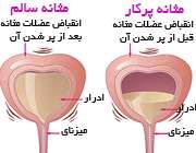 مثانه بیش فعال