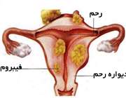فیبروم رحم زنان