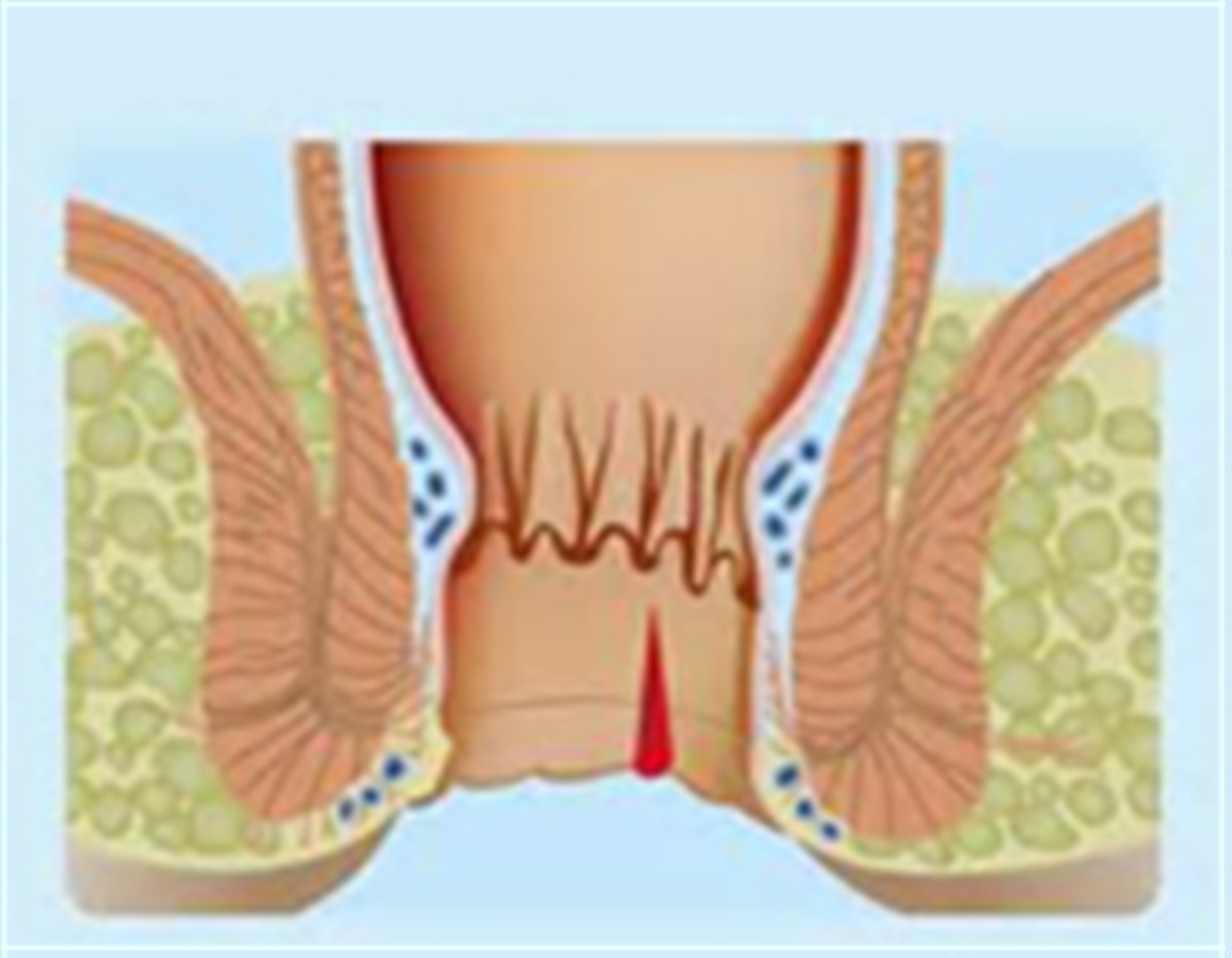 7 علت خارش مقعد